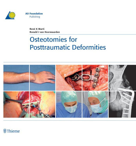 Osteotomies for posttraumatic deformities