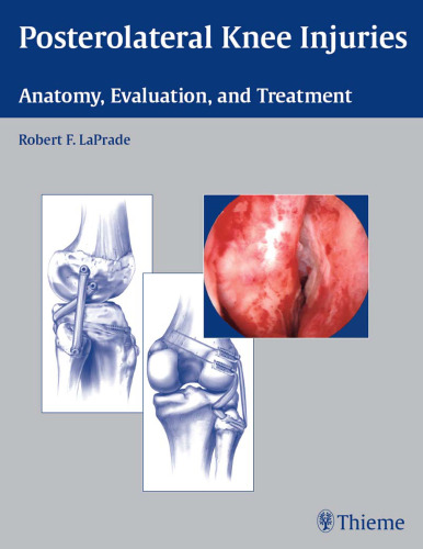 Posterolateral knee injuries: anatomy, evaluation, and treatment