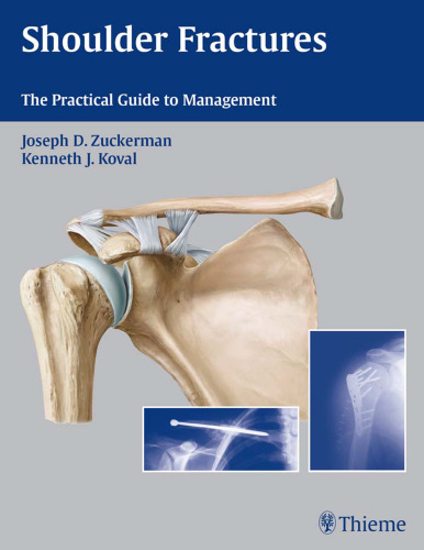 Shoulder fractures: the practical guide to management