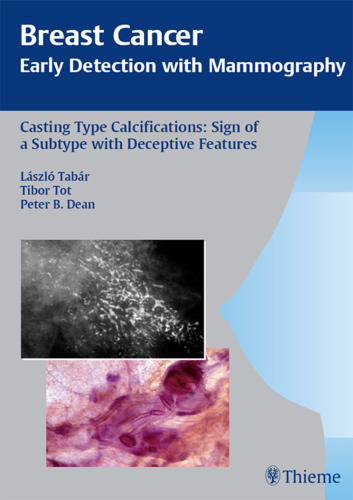 Casting Type Calcifications Sign of a Subtype with Deceptive Features