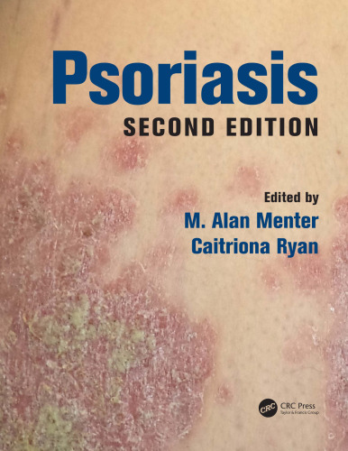 Psoriasis, Second Edition