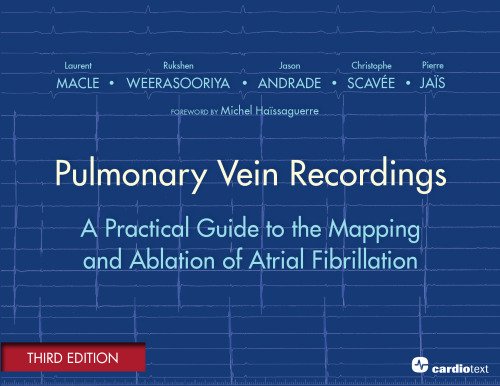 Pulmonary Vein Recordings: A Practical Guide to the Mapping and Ablation of Atrial Fibrillation