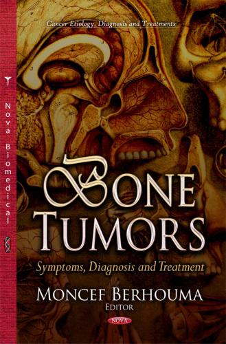 Bone tumours: symptoms, diagnosis, treatment