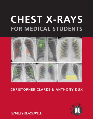 Chest X-rays for Medical Students