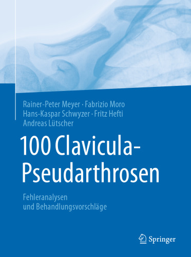 100 Clavicula-Pseudarthrosen: Fehleranalysen und Behandlungsvorschläge