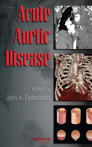 Acute aortic disease