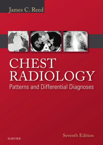 Chest Radiology: Patterns and Differential Diagnoses, 7e