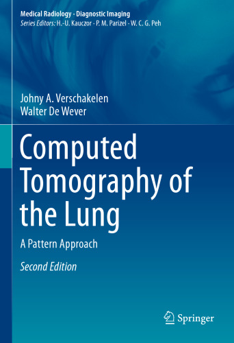  Computed Tomography of the Lung: A Pattern Approach