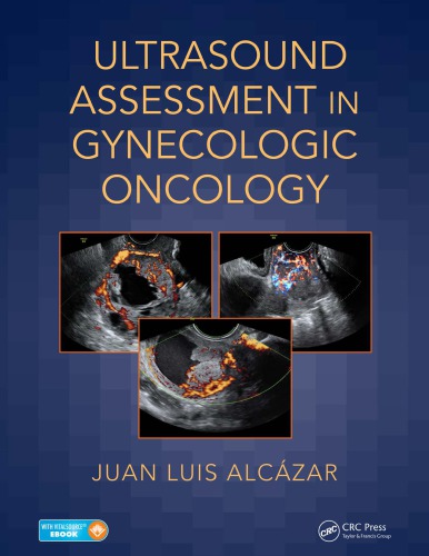 Ultrasound assessment in gynecologic oncology