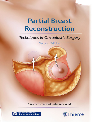 Partial Breast Reconstruction: Techniques in Oncoplastic Surgery