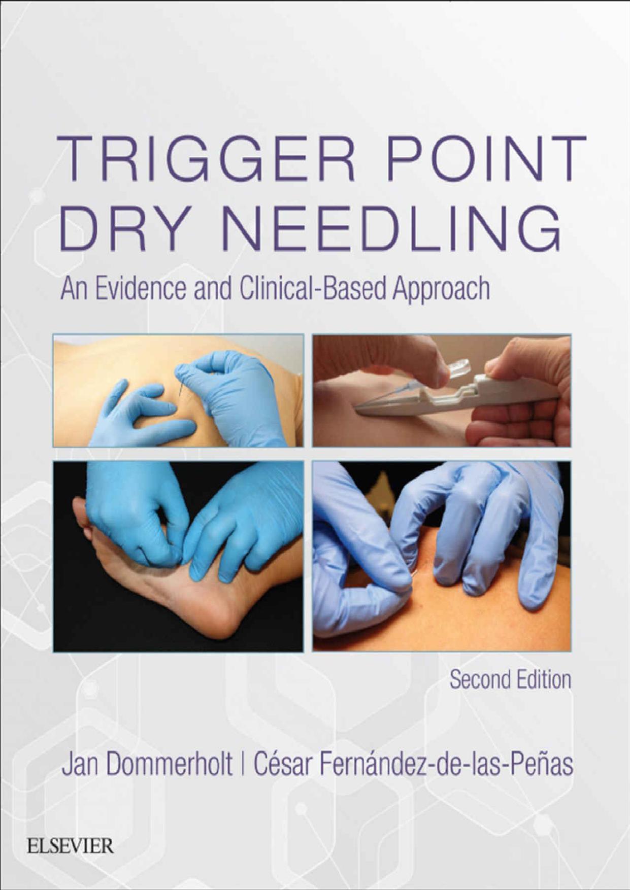 Trigger Point Dry Needling: An Evidence and Clinical-Based Approach