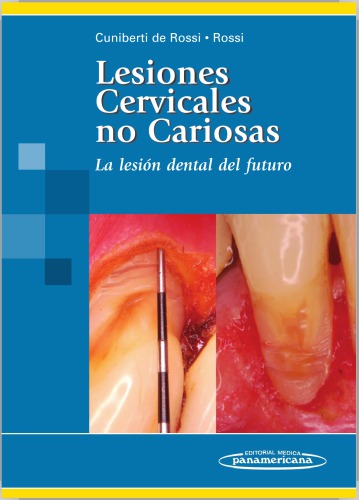 Lesiones Cervicales no Cariosas