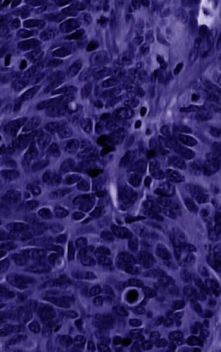 Lung Cancer: Molecular Pathology Methods and Reviews