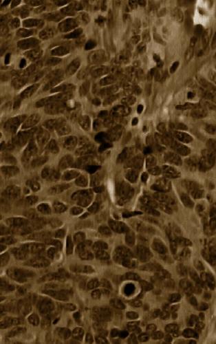 Lung Cancer: Diagnostic and Therapeutic Methods and Reviews