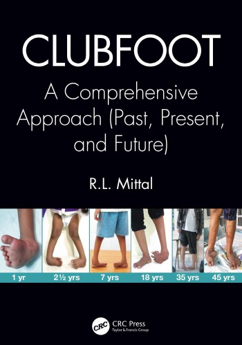Clubfoot: a Comprehensive Approach (Past, Present, and Future)