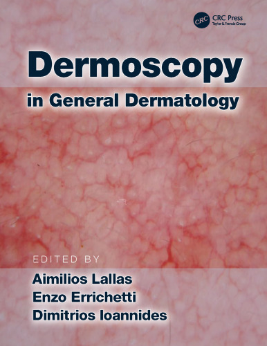 Dermoscopy in general dermatology