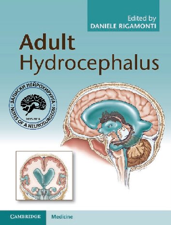Adult Hydrocephalus