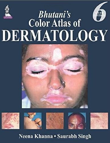 Bhutani's color atlas of dermatology.
