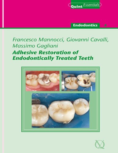 Adhesive Restoration of Endodontically Treated Teeth (Quintessentials of dental practice; v. 40)