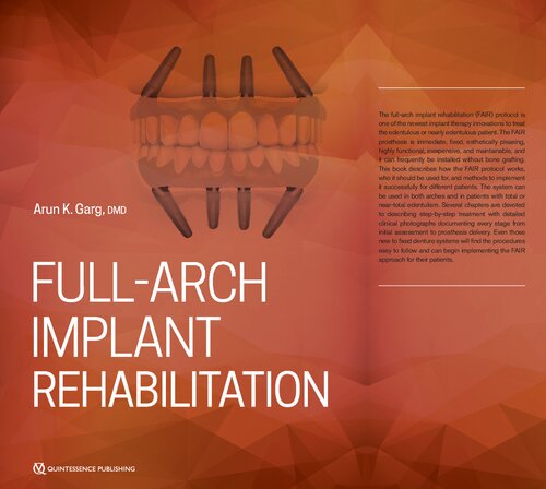 Full-Arch Implant Rehabilitation