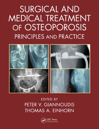 Surgical and Medical Treatment of Osteoporosis: Principles and Practice