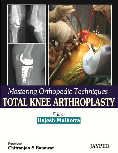 Total knee arthroplasty