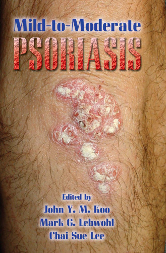 Mild-to-Moderate Psoriasis
