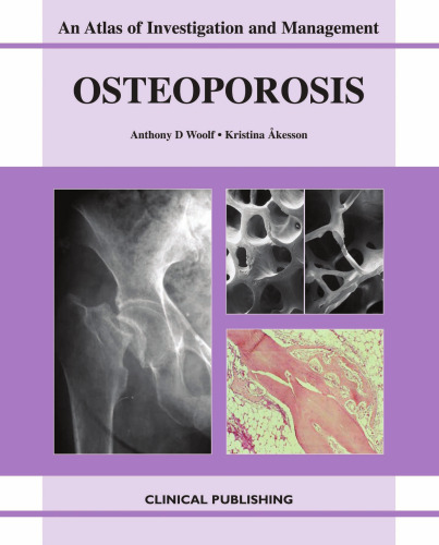 Osteoporosis: An Atlas Of Investigation And Diagnosis