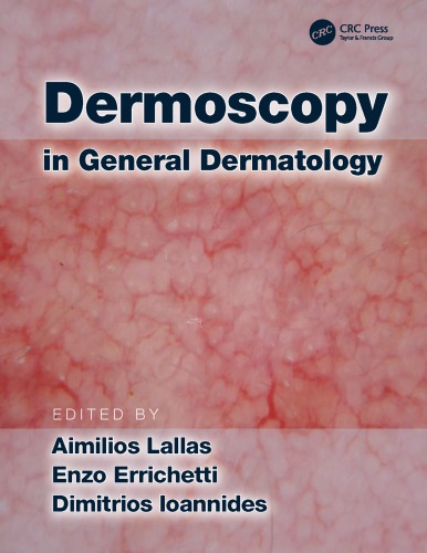 Dermoscopy in general dermatology