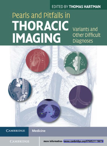 Pearls and pitfalls in thoracic imaging: variants and other difficult diagnoses