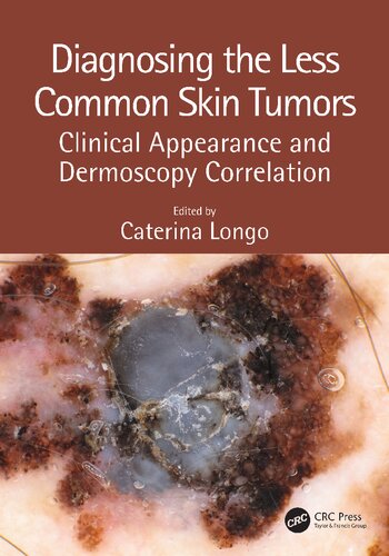 Diagnosing the Less Common Skin Tumors Clinical Appearance and Dermoscopy Correlation