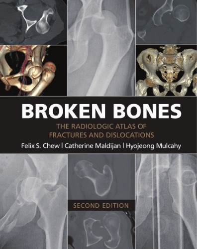 Broken bones - the radiologic atlas of fractures and dislocations
