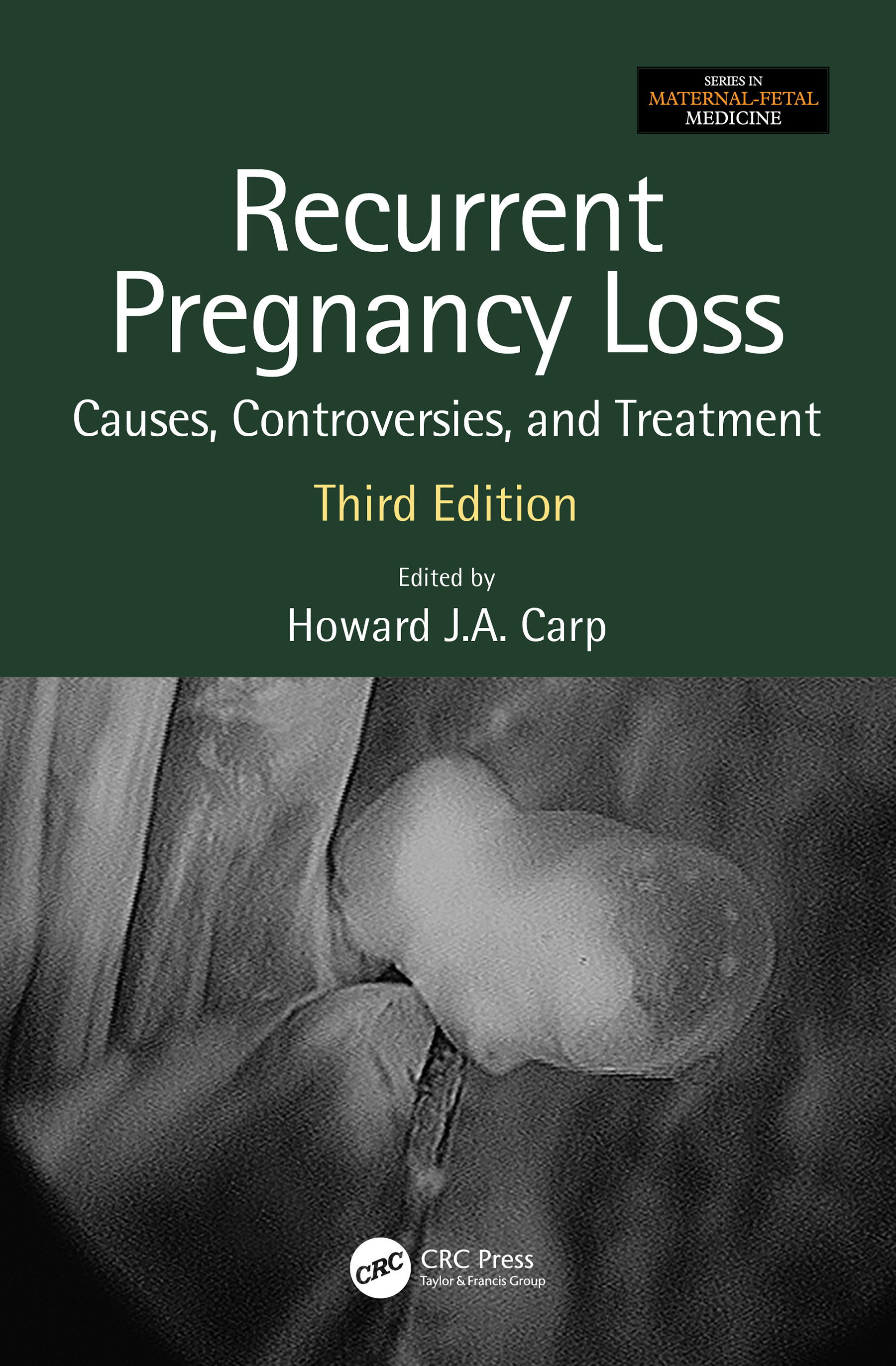 Recurrent Pregnancy Loss-Causes, Controversies and Treatment
