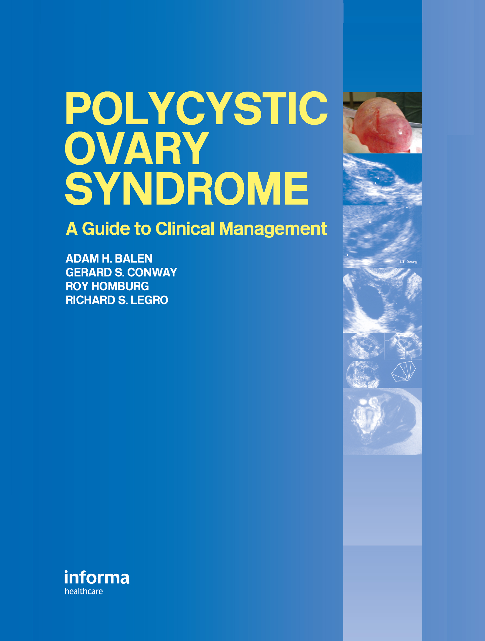 Polycystic Ovary Syndrome: A Guide to Clinical Management