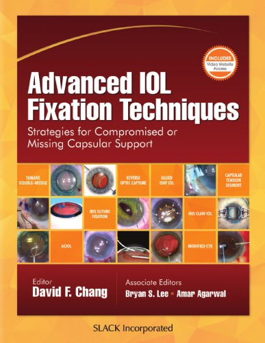 Advanced IOL Fixation Techniques: Strategies for Compromised or Missing Capsular Support