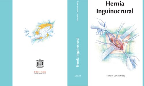 Hernia Inguinocrural