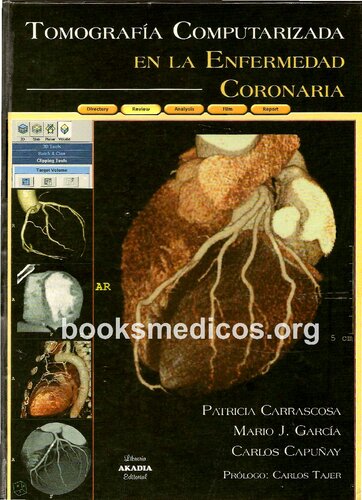 Tomografia Computarizada En La Enfermedad Coronaria