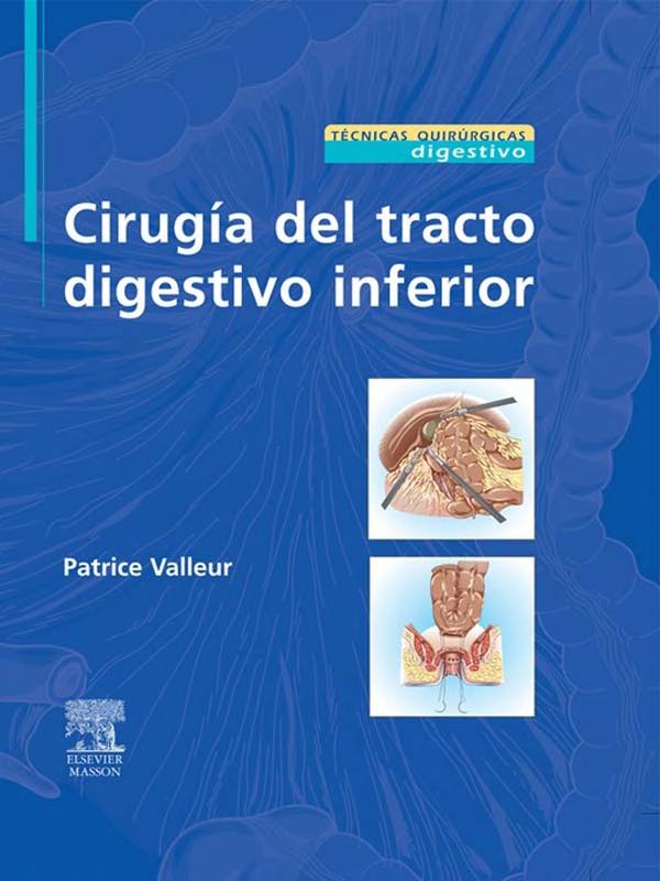 Cirugía del tracto digestivo inferior
