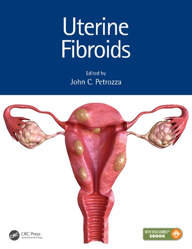 Uterine Fibroids