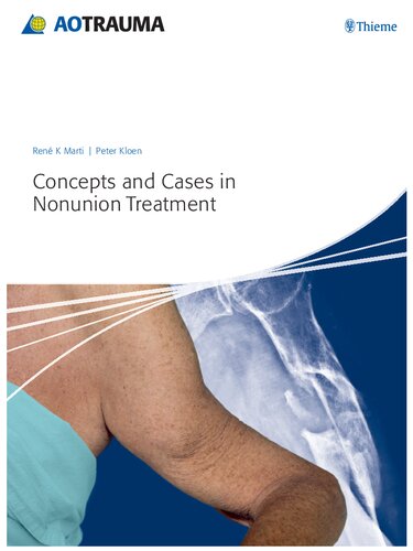 Concepts and Cases in Nonunion Treatment