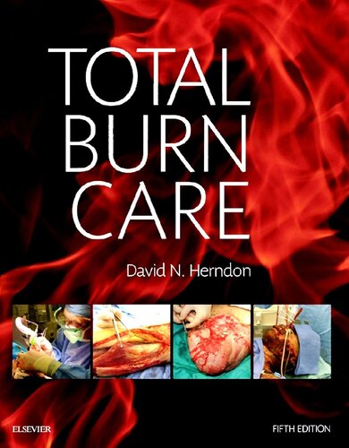 Total Burn Care