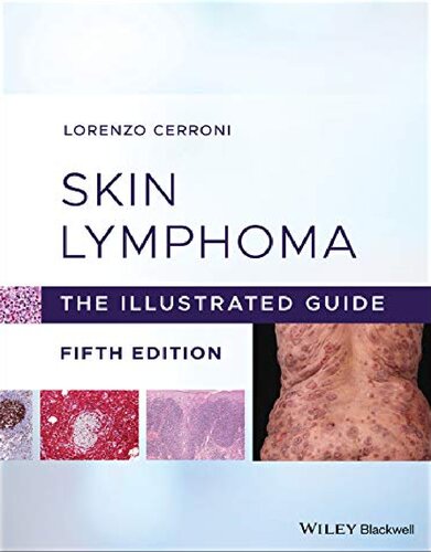 Skin lymphoma. The illustrated guide