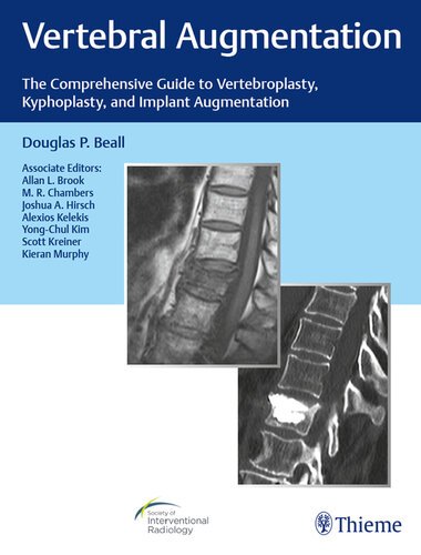 Vertebral augmentation the comprehensive guide to vertebroplasty, kyphoplasty, and implant augmentation