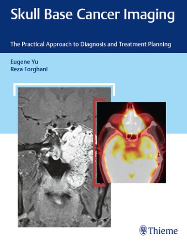 Skull base cancer imaging the practical approach to diagnosis and treatment planning