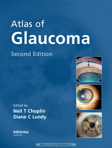 Atlas of Glaucoma