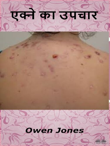 एक्ने का उपचार
