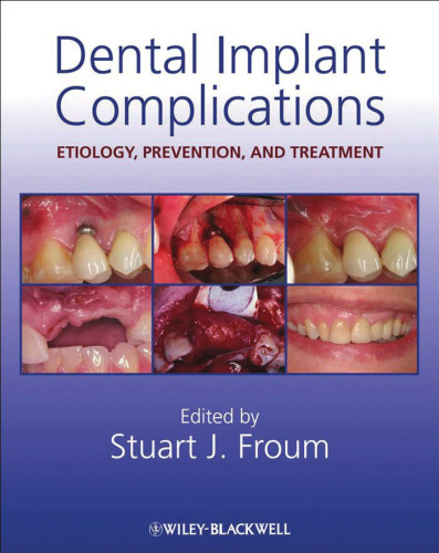 Dental Implant Complications: Etiology, Prevention, and Treatment