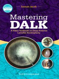 Mastering DALK : A Video Textbook on Deep Anterior Lamellar Keratoplasty