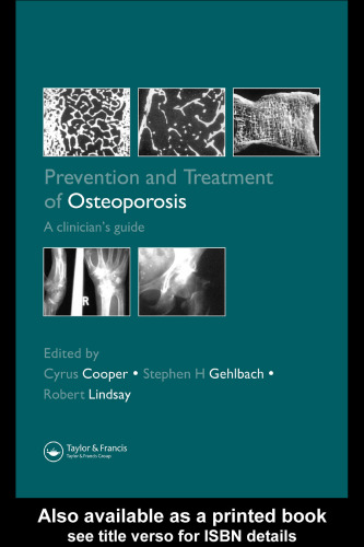 Prevention and Treatment of Osteoporosis in the High-Risk Patient: A Clinician's Guide