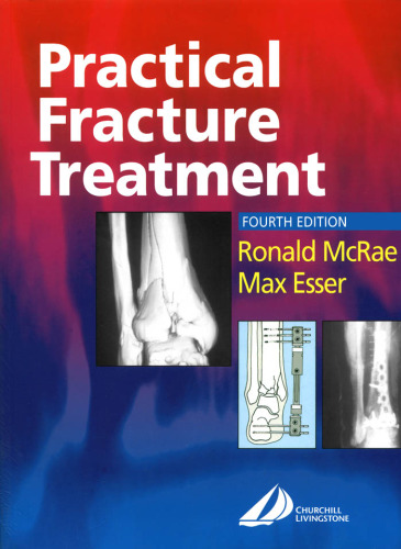 Practical Fracture Treatment, 4th edition